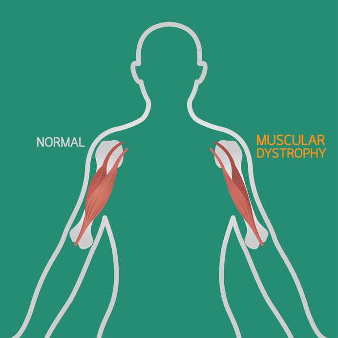 What is Muscular Dystrophy and How Does Muscle Therapy Help? 