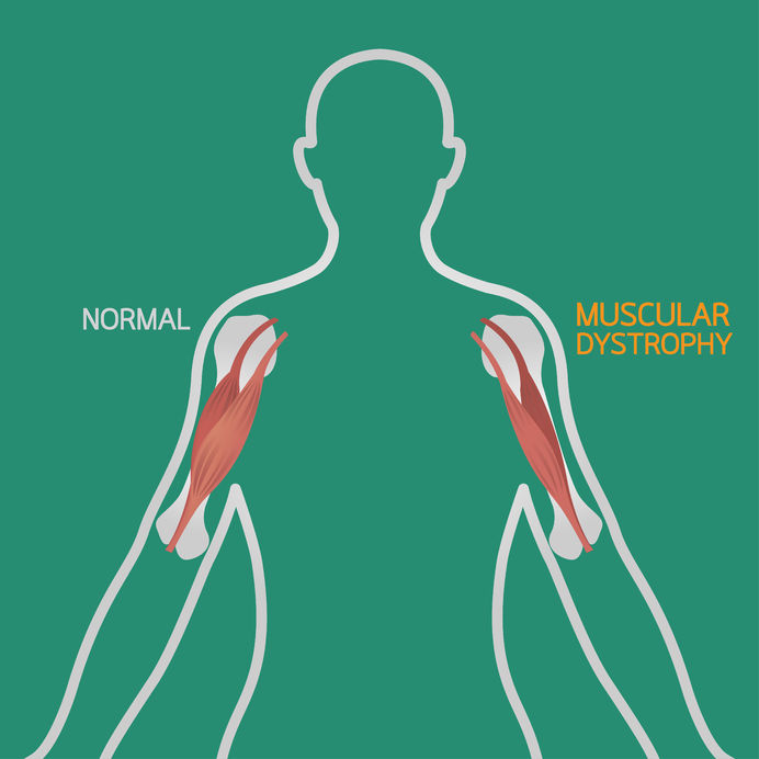 what-is-muscular-dystrophy-and-how-does-muscle-therapy-help