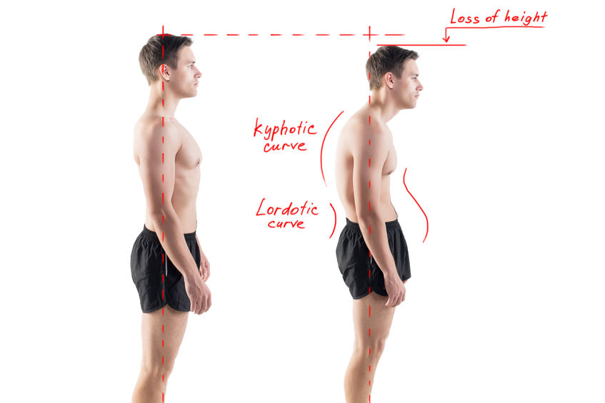 Man with impaired posture position defect scoliosis and ideal bearing.