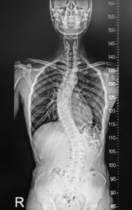 X-ray film of spine from person with scoliosis, a curvature of spine