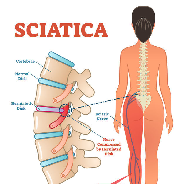 sciatica treatment