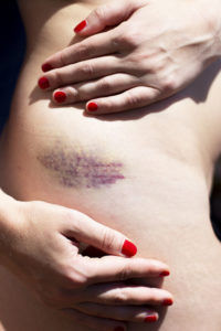 A bruise on the skin, hips, woman touching, showing her bruise