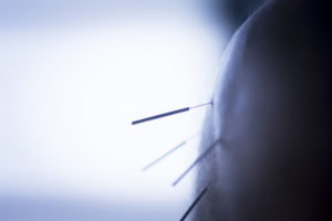 Dry needling acupuncture needles used by acupuncturist