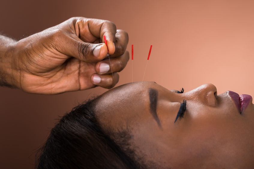 Close-up Of Young African Woman Receiving Acupuncture