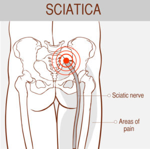 sciatica pain in the leg